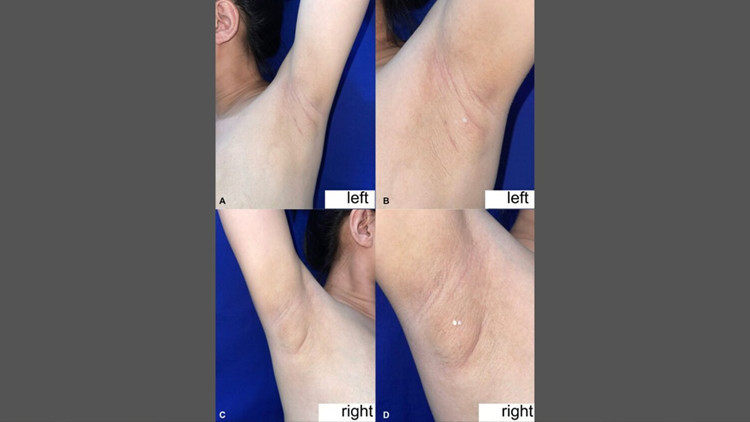 filipinli kadinin koltukaltindan sut geldi nadir gorulen durumun nedeni ne ZZMG3wVd.jpg